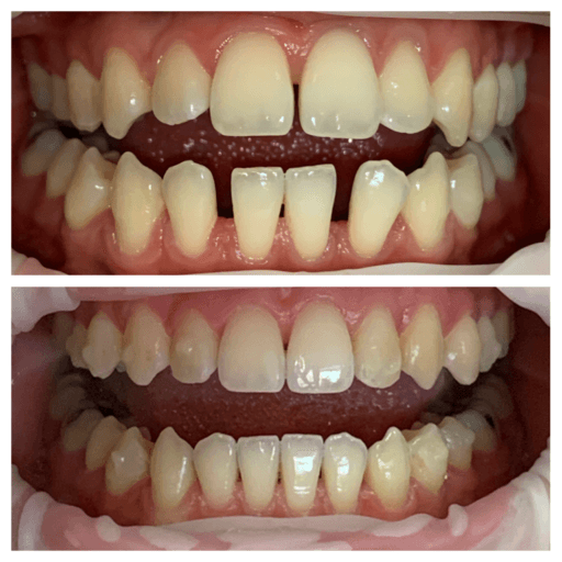 Before and after clear aligner treatment closing gaps between the front teeth