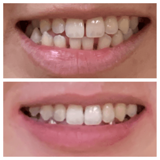 Before and after clear aligner treatment straightening crowded front teeth