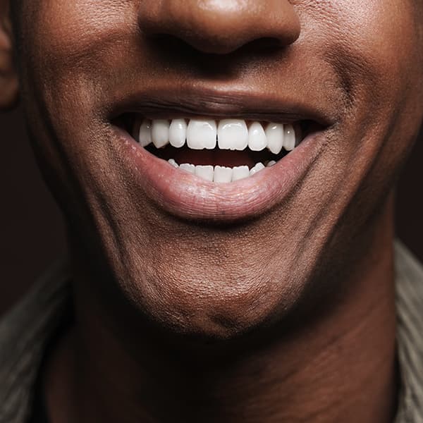 KöR teeth whitening system Beverly Hills